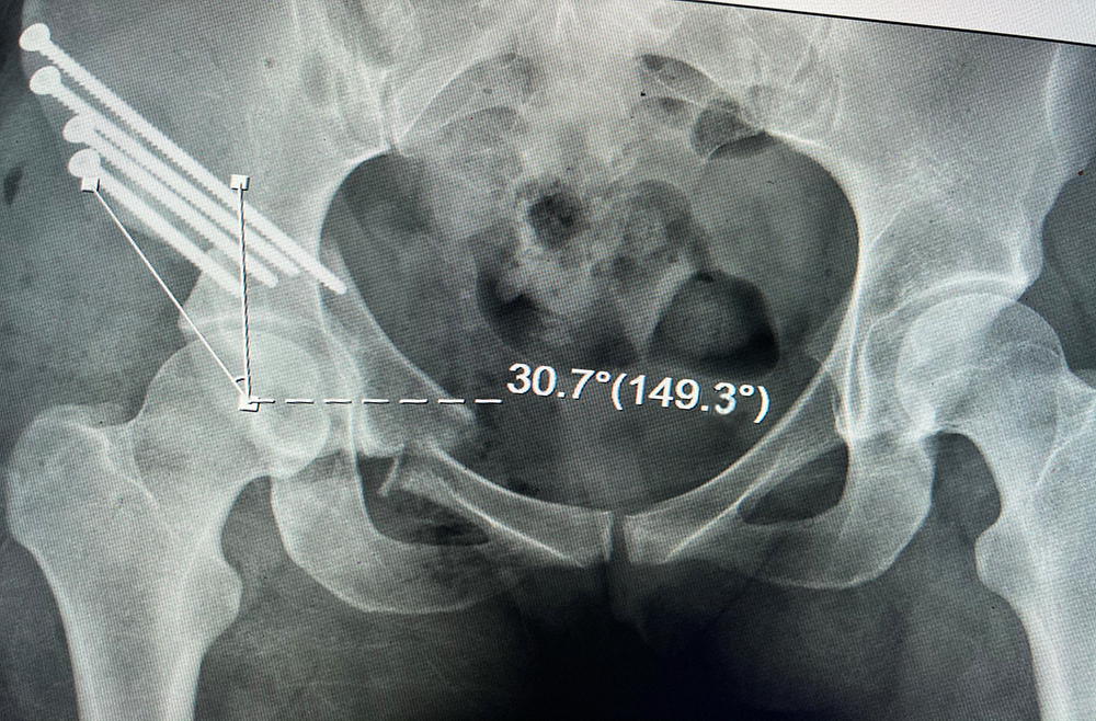 Dysplasia corrected with screws.